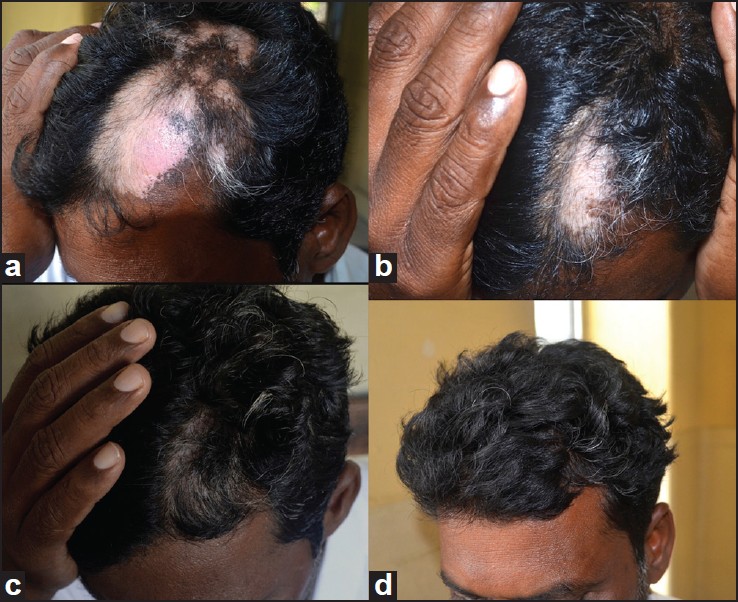 Alopecia areata - Vitiligo overlap syndrome: An emerging clinical variant -  Indian Journal of Dermatology, Venereology and Leprology