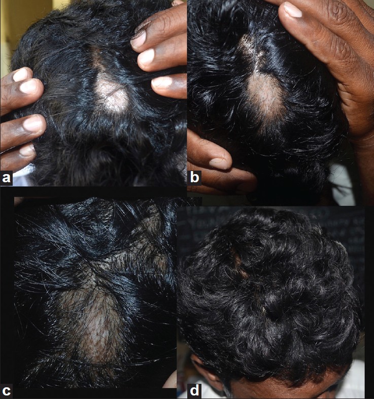Alopecia areata - Vitiligo overlap syndrome: An emerging clinical variant -  Indian Journal of Dermatology, Venereology and Leprology