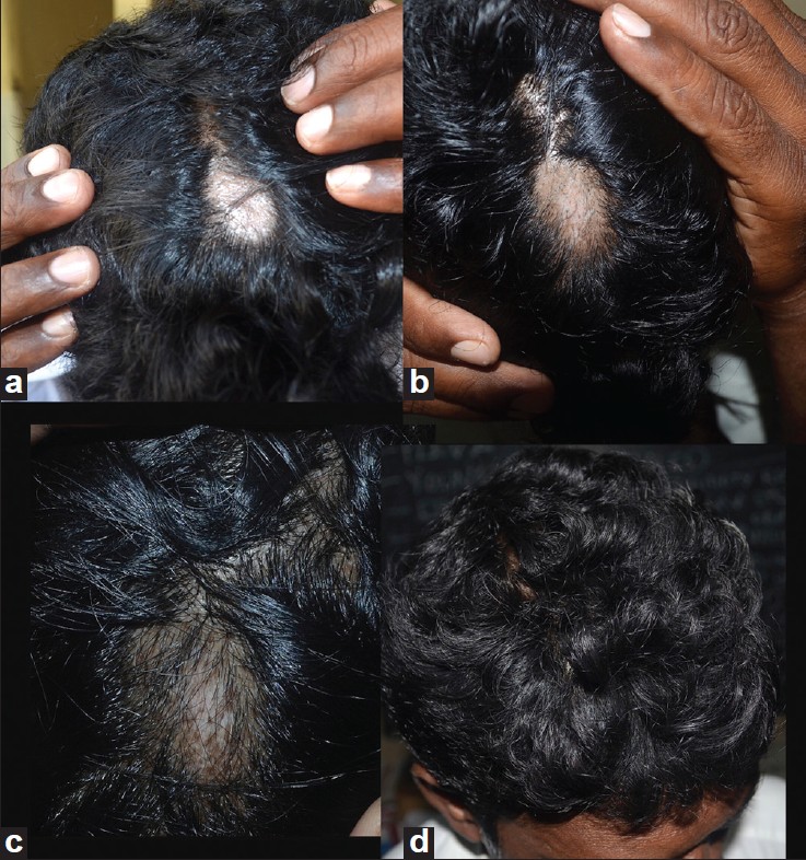 Indian Journal Of Dermatology Venereology And Leprology Alopecia Areata Vitiligo Overlap Syndrome An Emerging Clinical Variant