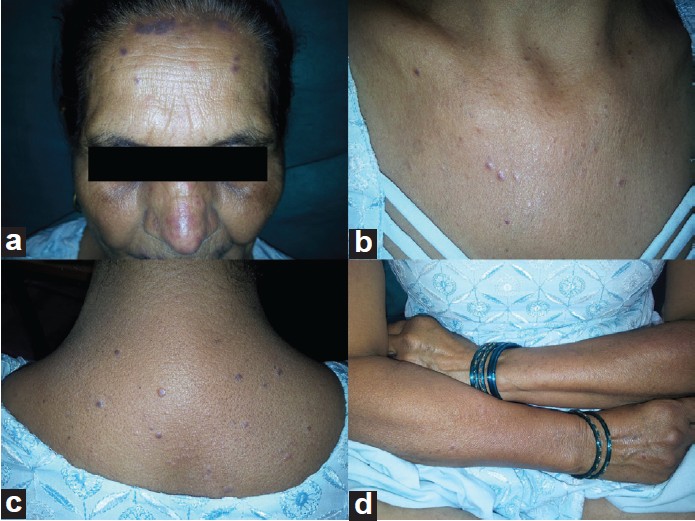 Sulfasalazine induced lichen planus in a patient of rheumatoid