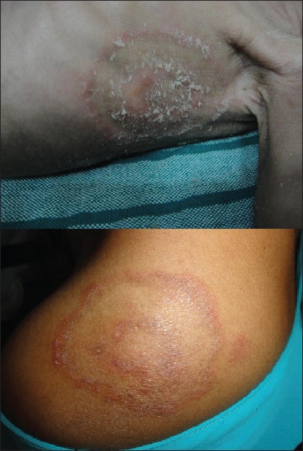 TINEA CORPORIS, BEST SKIN DOCTOR IN KRISHNAGIRI