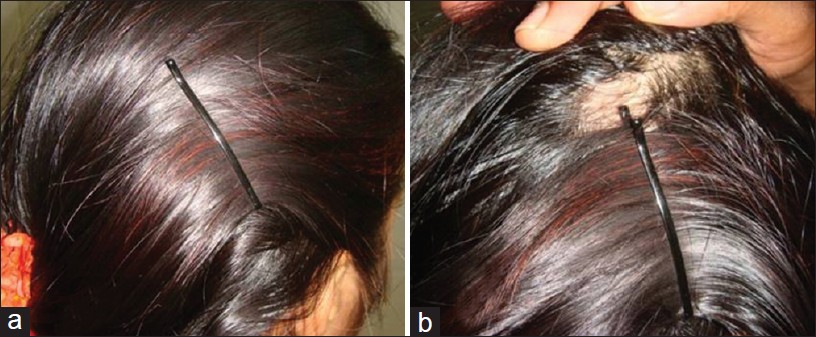 clobetasol propionate for hair loss