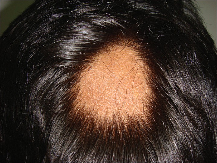 clobetasol propionate for hair loss