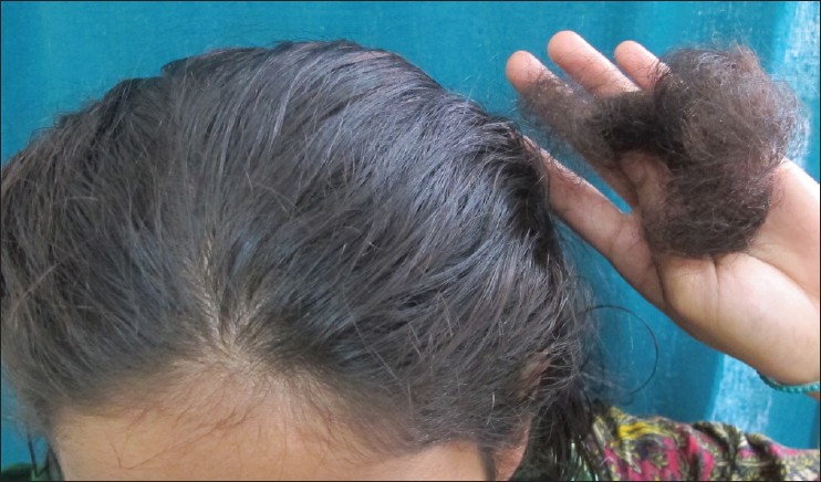 Heavy hair loss the global treatment program  BioNike