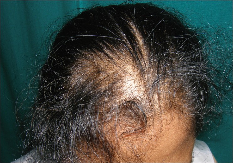 Zinc deficiency hair loss reversal