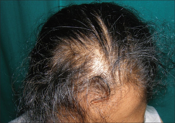 Deficiency hair reversal zinc loss Can You