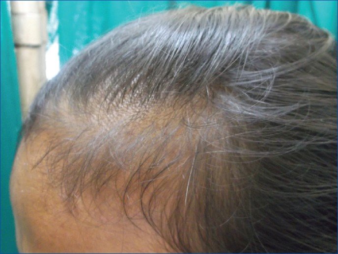 Androgenetic alopecia or Telogen Efflvium  What is my diagnosis  Donovan  Hair Clinic