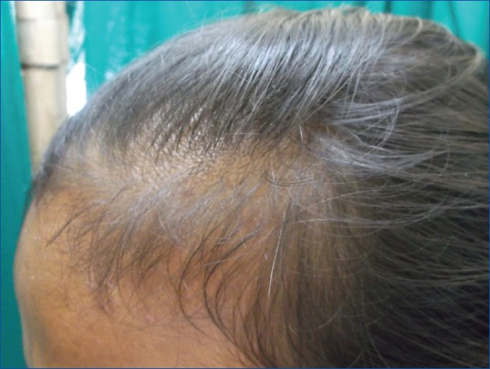 Telogen effluvium - Indian Journal of Dermatology, Venereology and Leprology