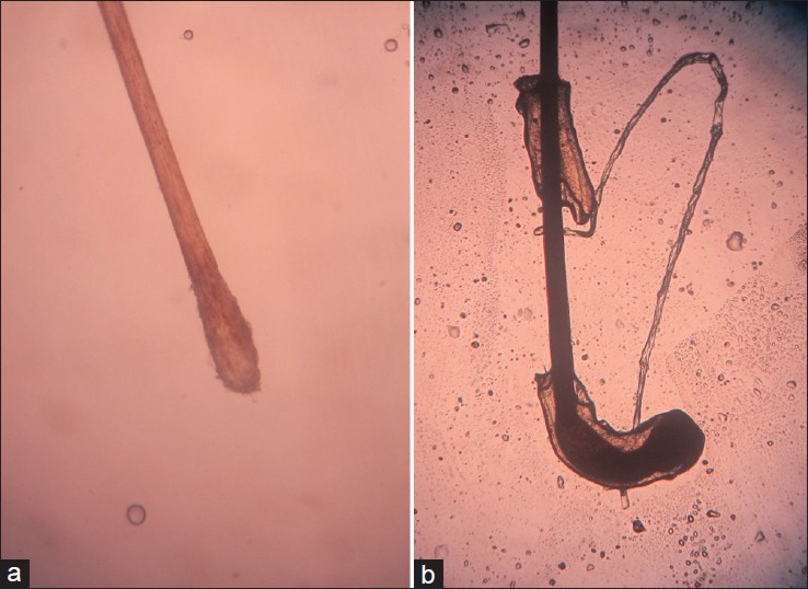 Telogen Effluvium Indian Journal Of Dermatology Venereology And Leprology