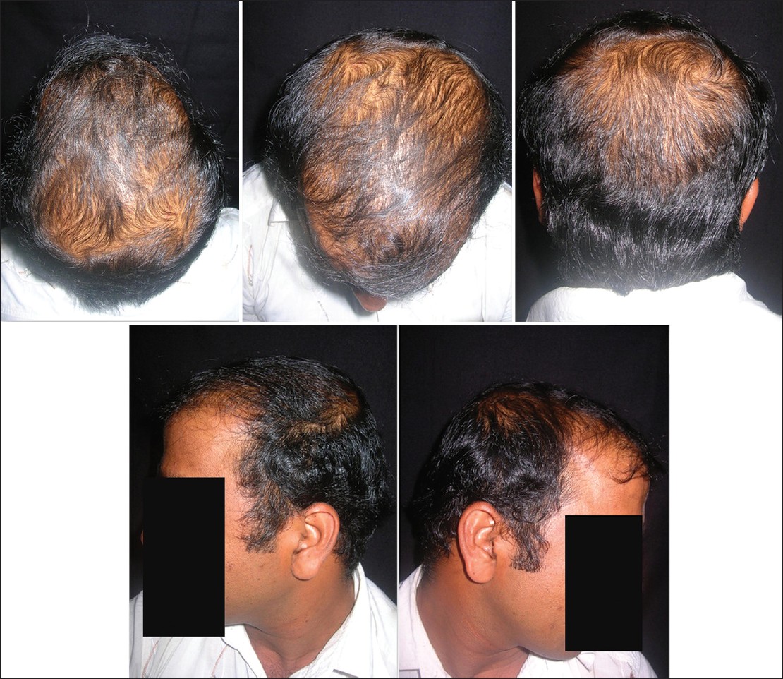 Top more than 64 androgenic hair loss - in.eteachers