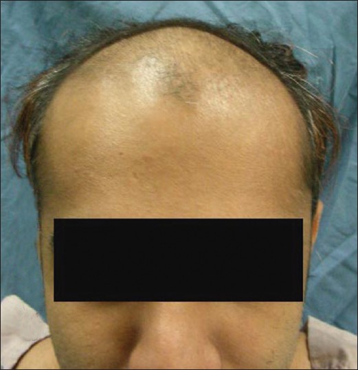 Androgenetic alopecia: An update - Indian Journal of Dermatology,  Venereology and Leprology