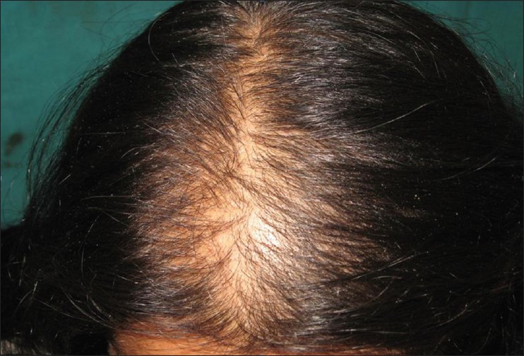 Female pattern hair loss - Indian Journal of Dermatology, Venereology and  Leprology