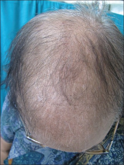 Hair Loss in Women Different than in Men Now Assured Better Treatment