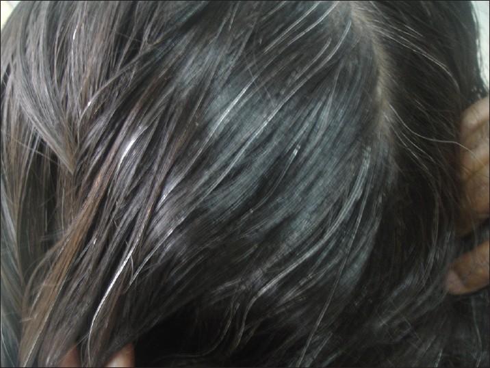 Premature graying of hair - Indian Journal of Dermatology, Venereology and  Leprology