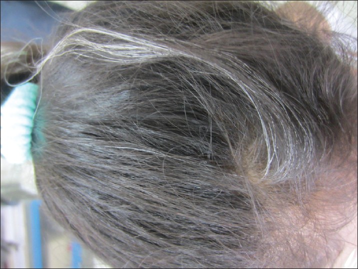 Greying Hair Tips  Advice From Top Doctors  Lybrate