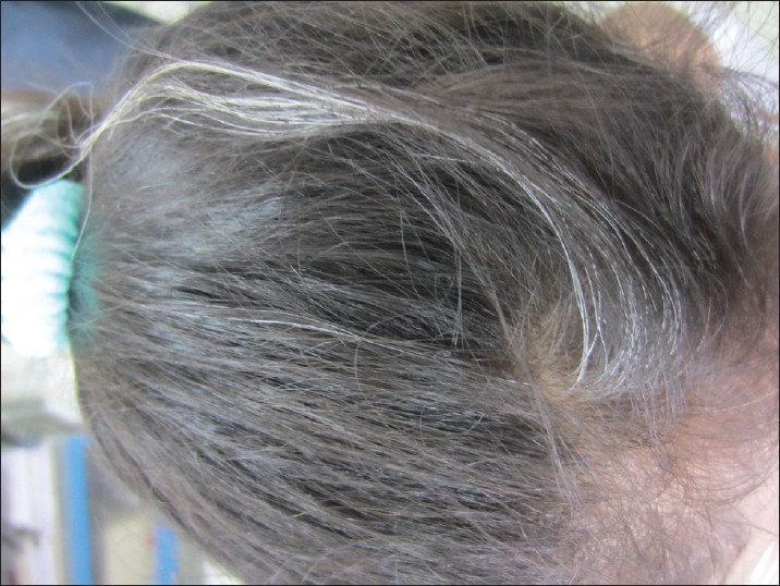 Premature graying of hair - Indian Journal of Dermatology, Venereology ...