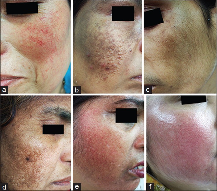 Skin lightening agents Use or abuse? A retrospective analysis of