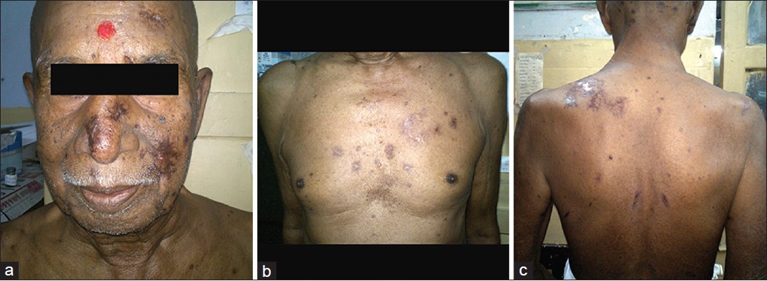 Disseminated Hsv Lips