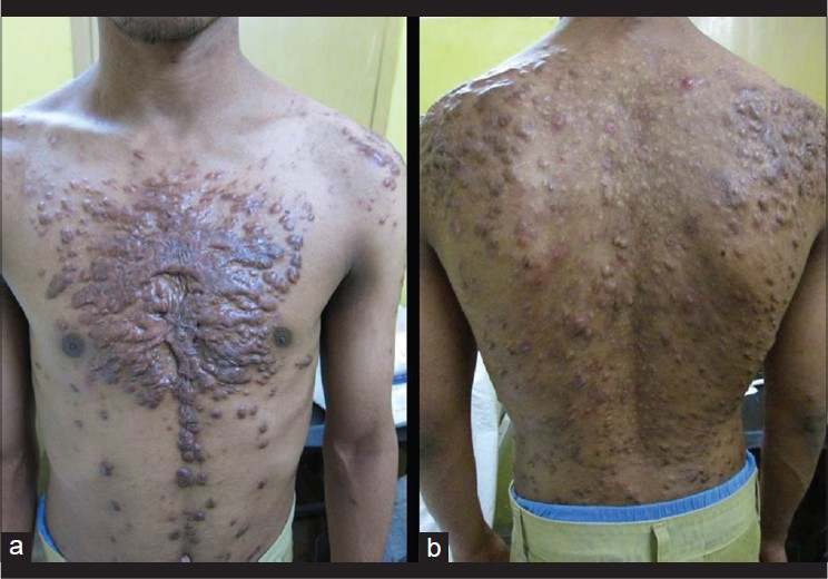 Keloids in Rubinstein–Taybi syndrome: a clinical study - Kar