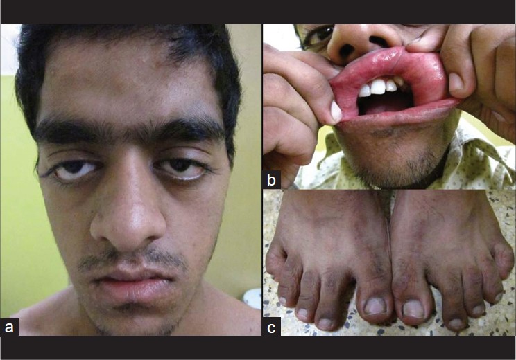 Rubinstein-Taybi syndrome-showing distinctive clinical features