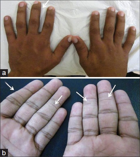 Rubinstein-Taybi syndrome: A report of two siblings with