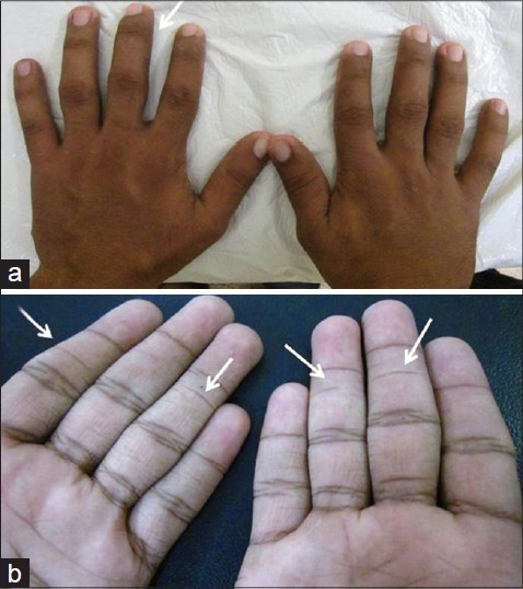 Rubinstein-Taybi syndrome-showing distinctive clinical features