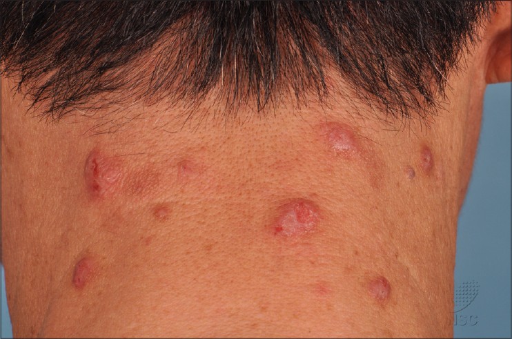 actinic prurigo symptoms