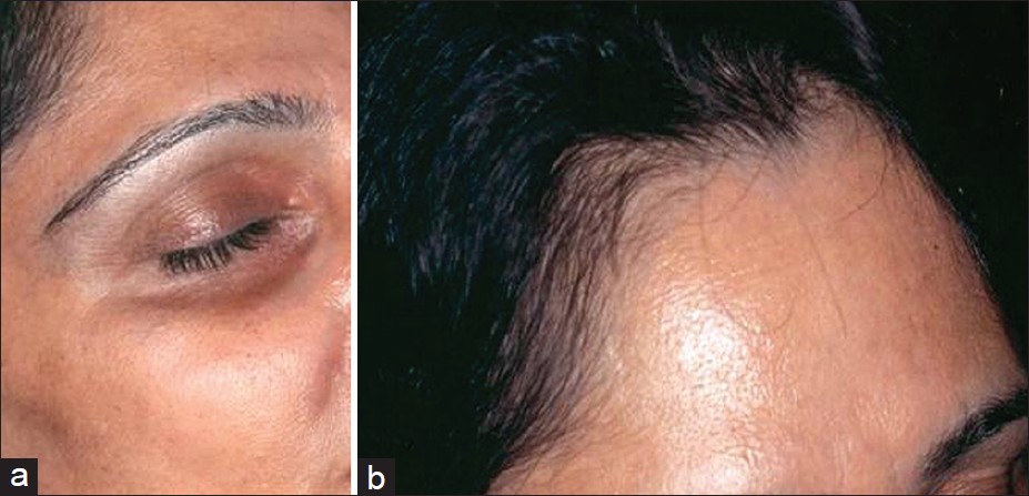 Argyria an unrecognized cause of cutaneous pigmentation in Indian ...