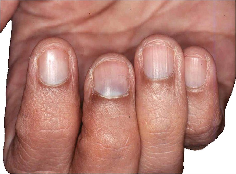 If you see any of these nail anomalies, get medical help right once.
