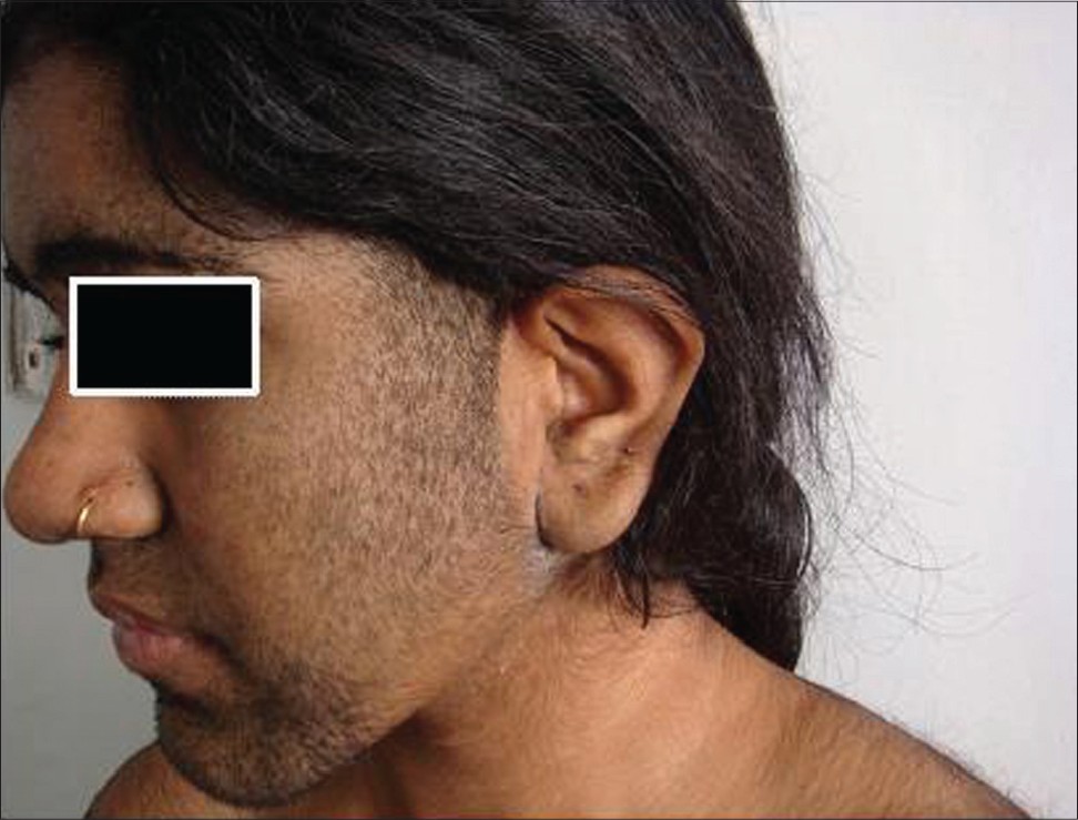 Familial congenital generalized hypertrichosis Indian Journal of