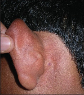 A T R Icky Mole Behind The Ear Indian Journal Of Dermatology Venereology And Leprology