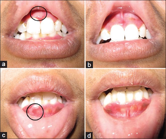 Bullous Pemphigoid In Oral Cavity