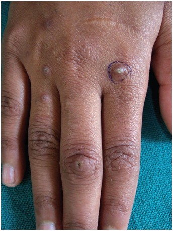 acquired perforating dermatosis