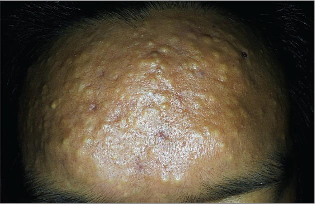 Facial Eruptive Vellus Hair Cysts Occurred after 3% Minoxidil Application