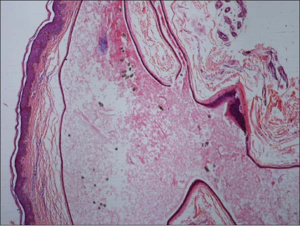 eruptive vellus hair cysts face