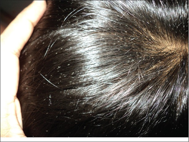 Hair casts - Indian Journal of Dermatology, Venereology and Leprology