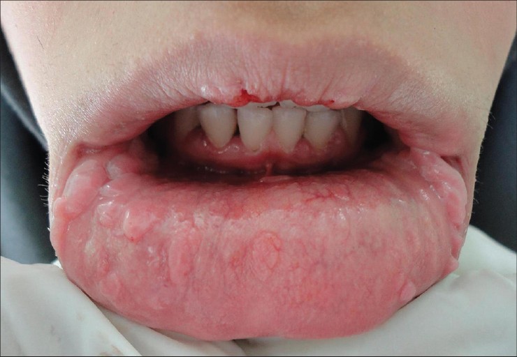 Filiform Wart Tongue