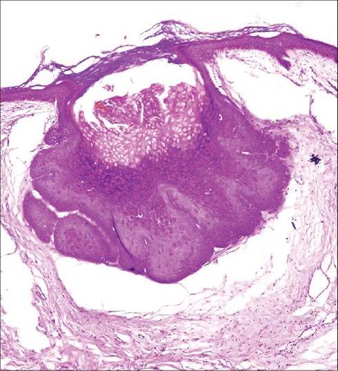 Disseminated molluscum contagiosum in a patient on methotrexate therapy ...