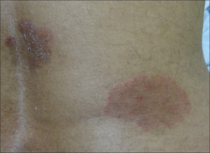 Lesions of tinea corporis on back