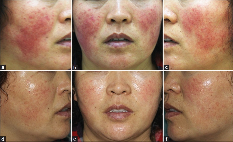 Effects Of Low Level Light Therapy On Facial Corticosteroid Addiction Dermatitis A 