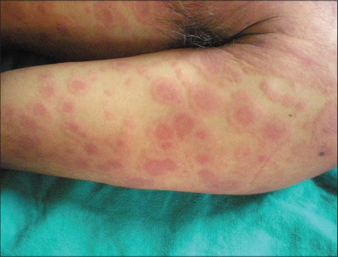 Síndrome DRESS (Drug reaction with eosinophilia and systemic symptoms), Diapositivas de Dermatología