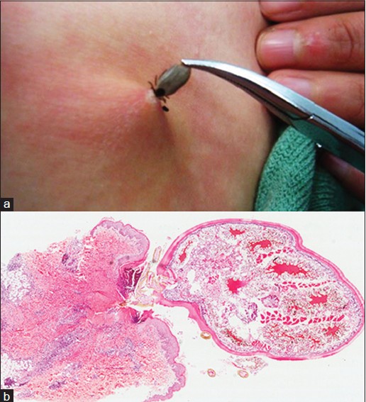 Post tick bite granuloma