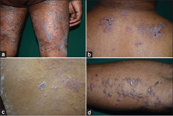 vesicular lichen planus