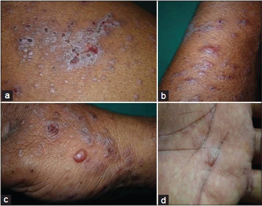 vesicular lichen planus