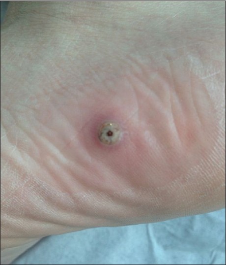 Dermoscopy in tungiasis - Indian Journal of Dermatology, Venereology ...