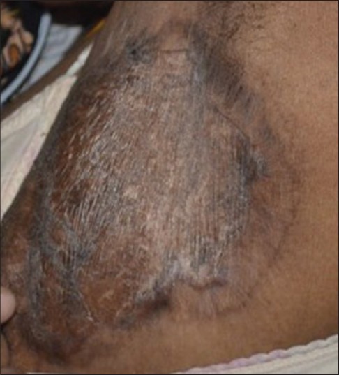 Hidradenitis suppurativa treated with carbon dioxide laser followed by  split skin thickness graft - Indian Journal of Dermatology, Venereology and  Leprology