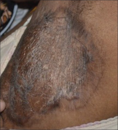 Hidradenitis suppurativa treated with carbon dioxide laser