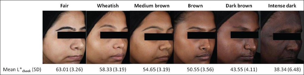 Indian Journal Of Dermatology Venereology And Leprology Skin Complexion And Pigmentary Disorders In Facial Skin Of 14 Women In 4 Indian Cities