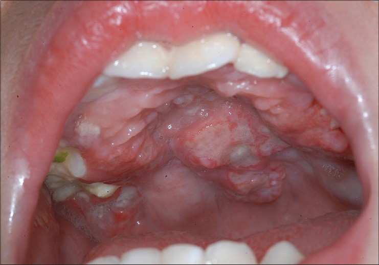 langerhans cell histiocytosis jaw