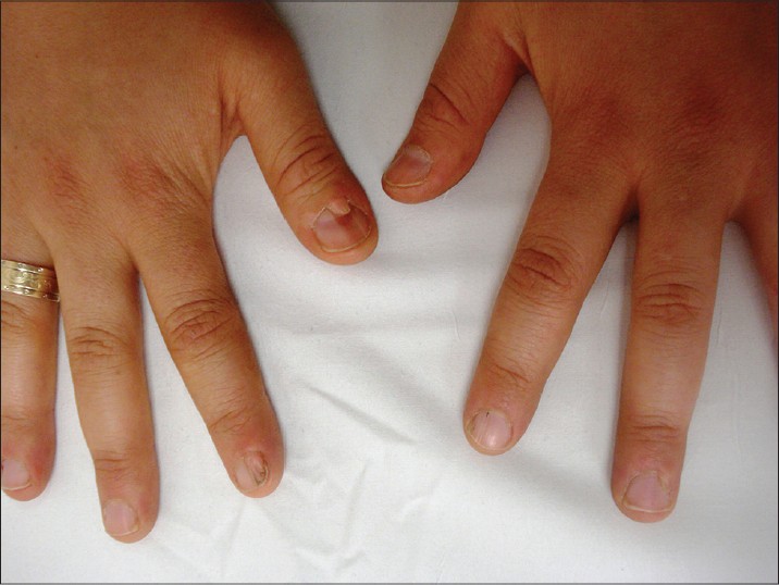 Giant cell angiofibroma of gingiva in tuberous sclerosis complex: a case  report and literature review | Diagnostic Pathology | Full Text